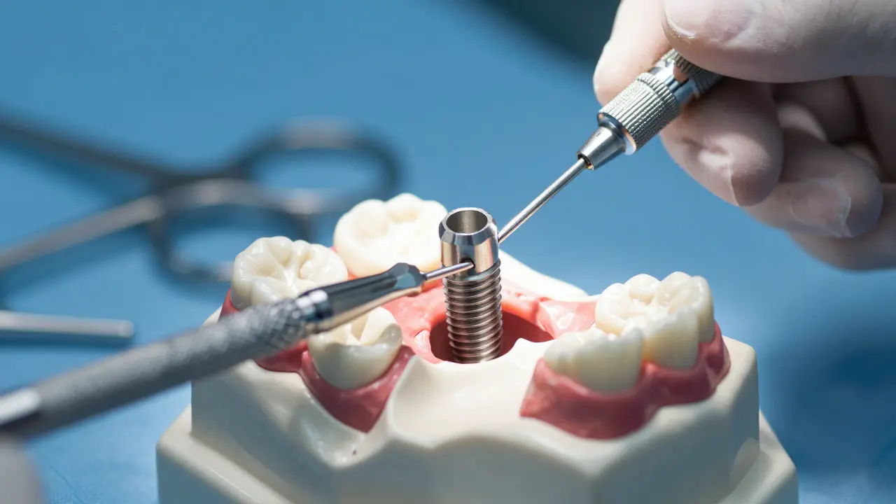 Detailní záběr titanového zubního implantátu v kosti